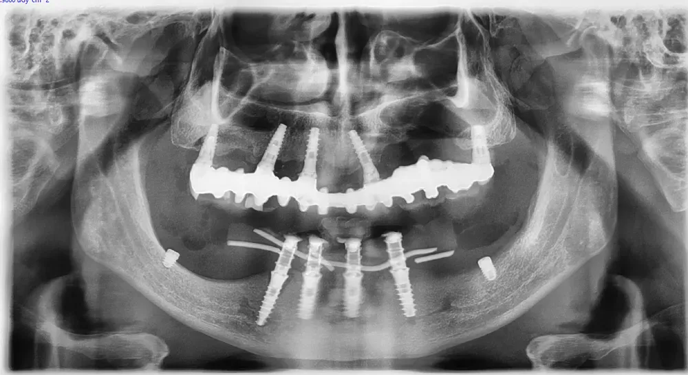 lower immediate loading with posterior short implants