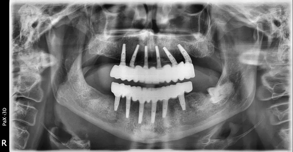 all on six and zirconia