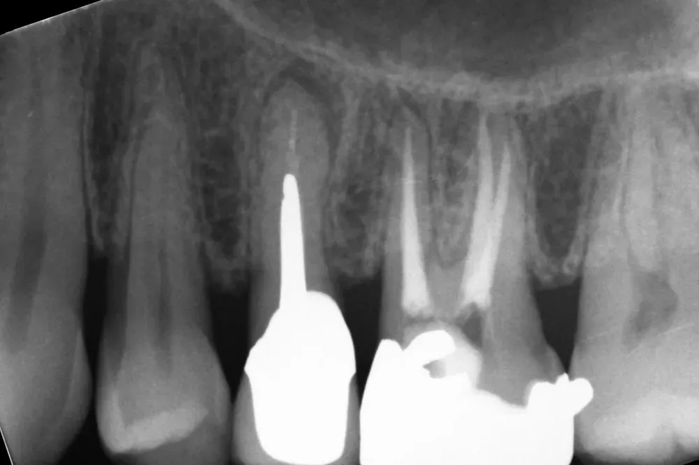 Fractured upper premolar before treatment