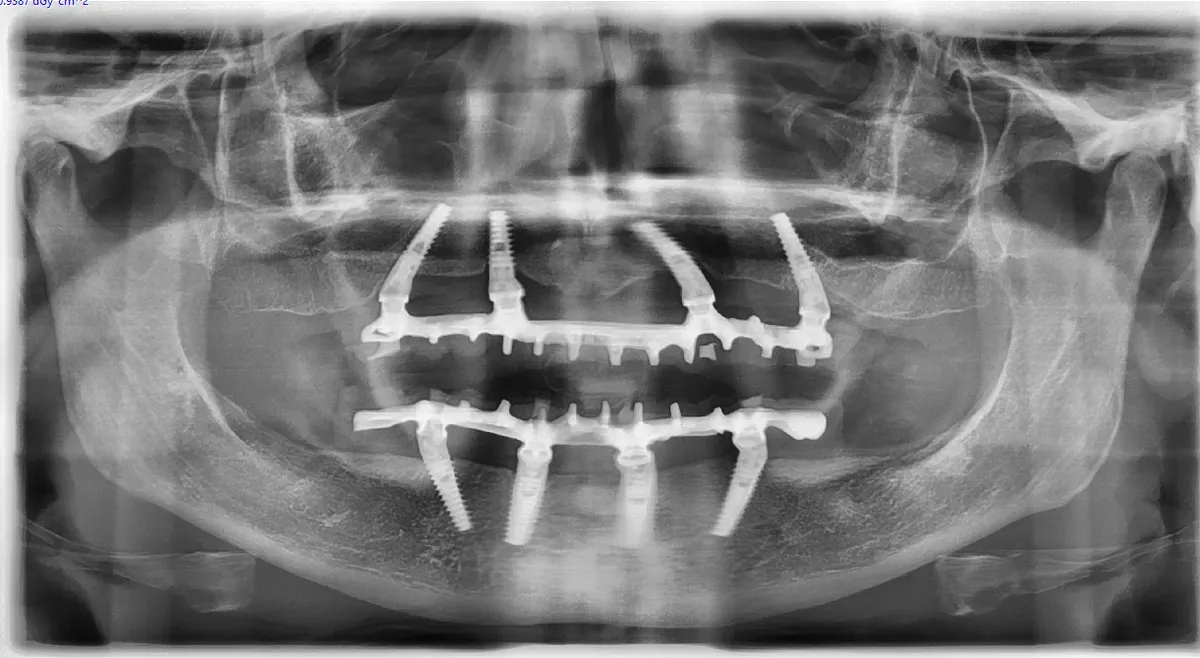 Immediate Loading: Technique, Benefits and When It's Indicated