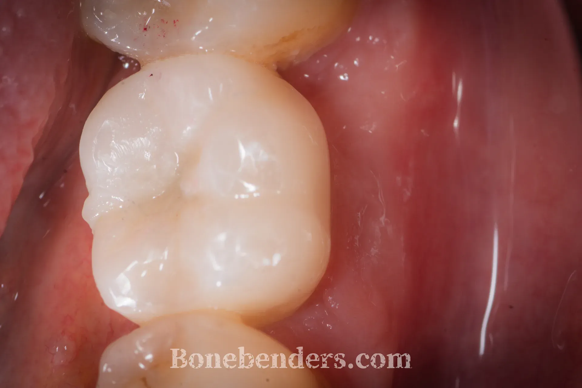 Stessa veduta occlusale a riabilitazione conclusa: corona singola in zirconia avvitata sull'impianto in sede 3.6, con anatomia occlusale e mucosa perimplantare rosa e aderente.