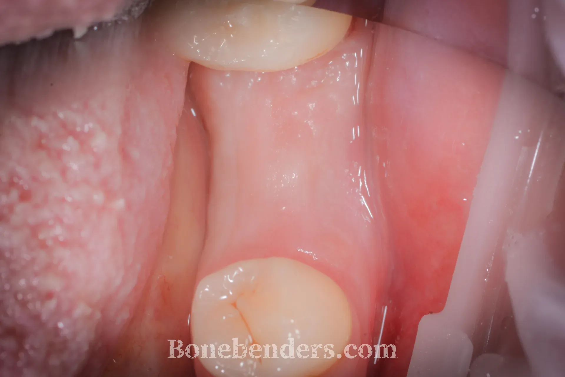 Veduta occlusale del sito 3.6 edentulo prima del trattamento: mucosa cheratinizzata continua fra il premolare mesiale e il molare distale, profilo crestale apparentemente regolare.