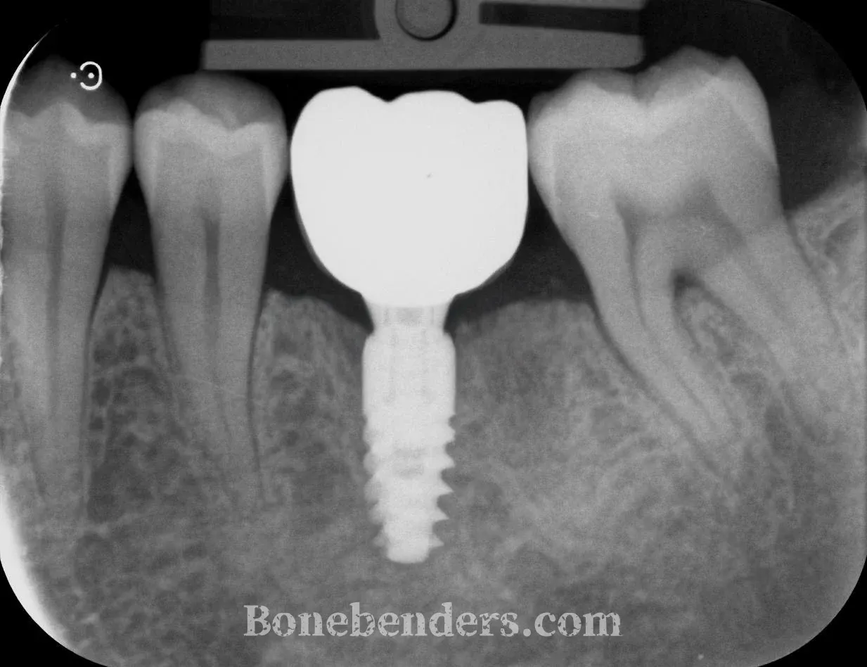 Radiografia endorale del sito 3.6 alla consegna della corona: impianto osteointegrato fra premolare e secondo molare, osso crestale adeso al collo implantare su entrambi i versanti.