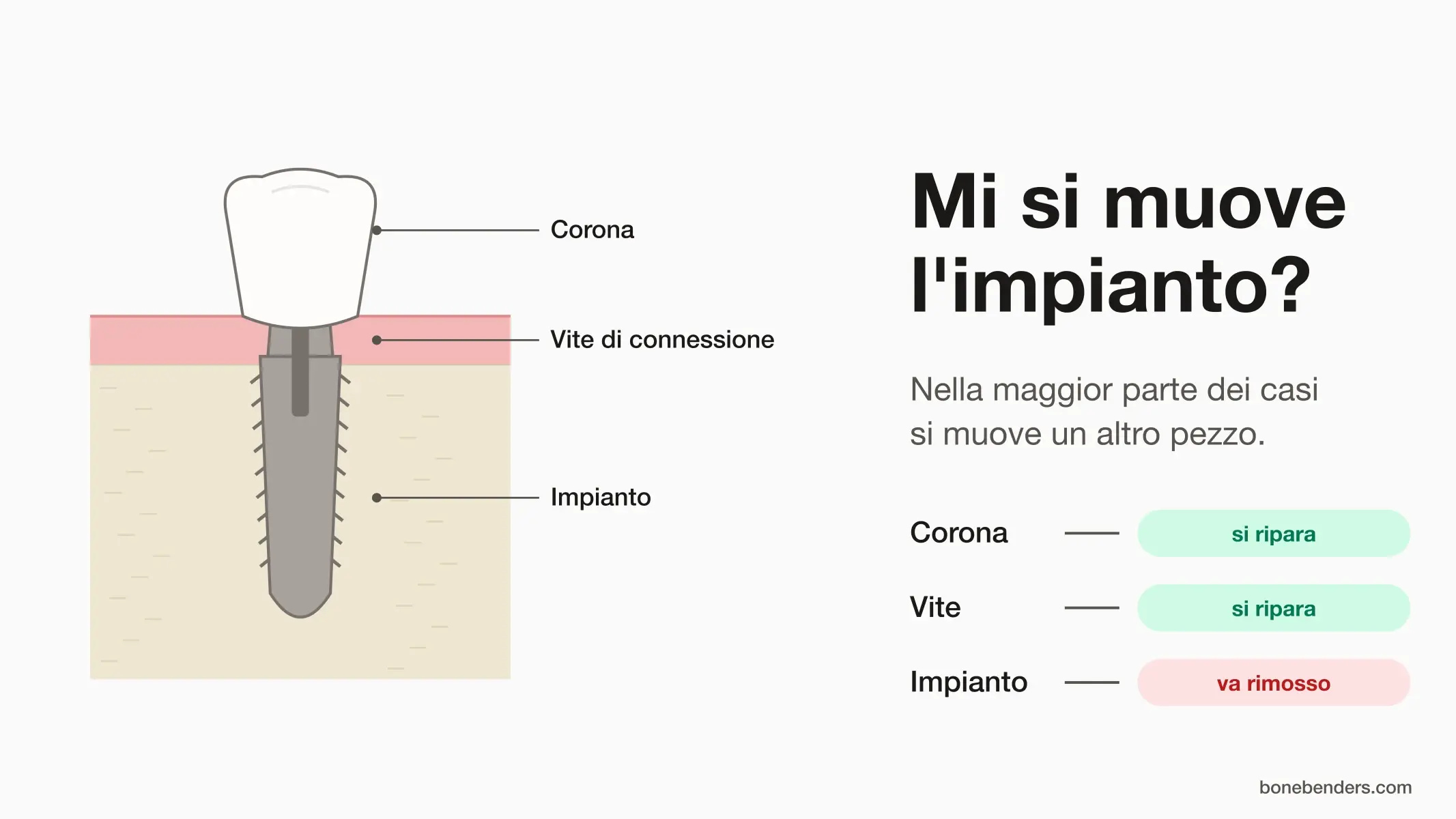 Schema di un impianto dentale con corona, vite di connessione e impianto: corona e vite si riparano, l'impianto mobile va rimosso