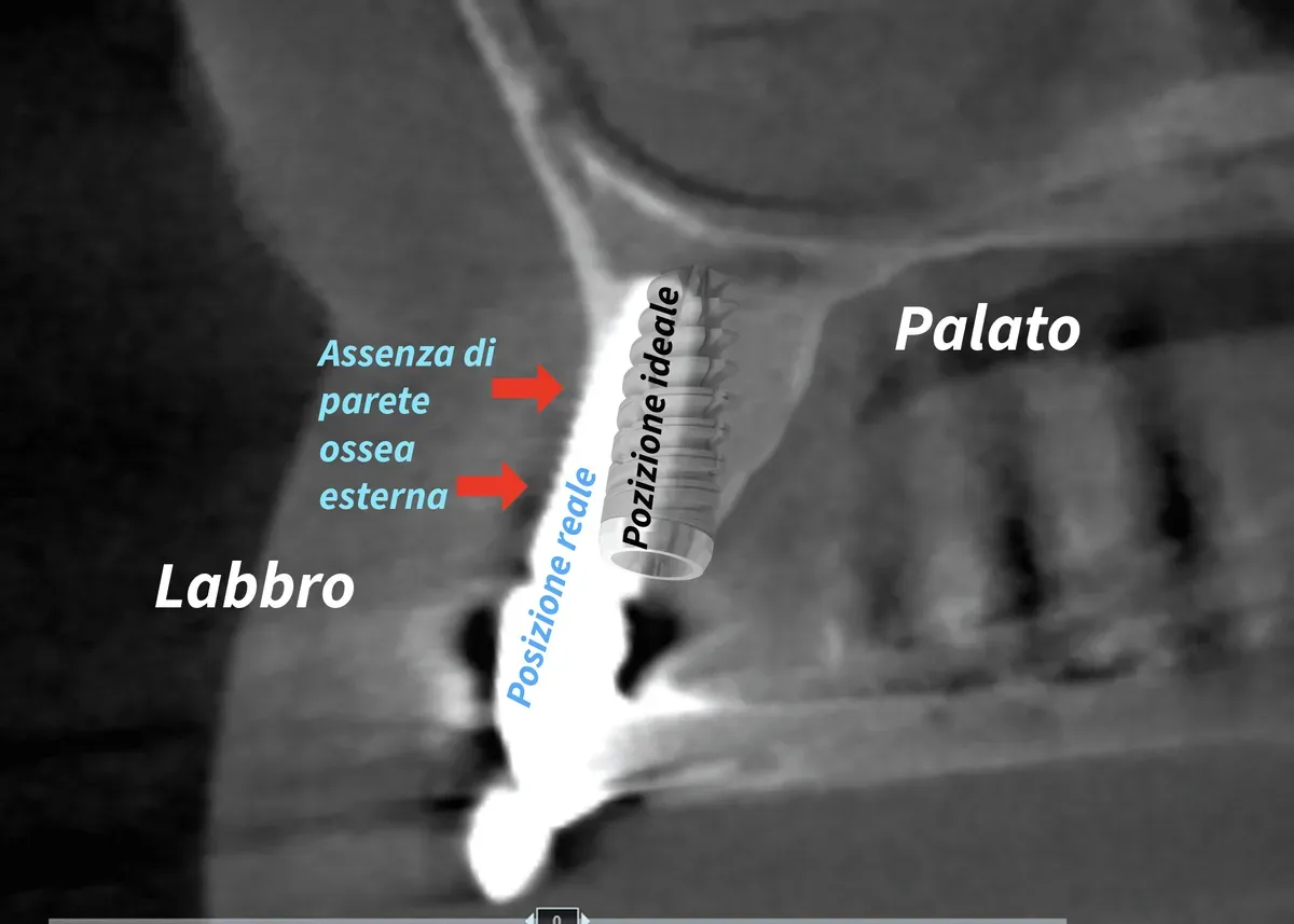 Impianto Dentale Mal Posizionato: Rischi, Sintomi e Soluzioni