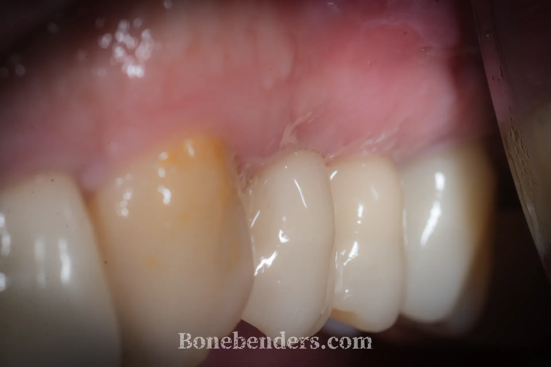 Corona in ceramica su impianto in zona primo premolare superiore sinistro — risultato clinico a 4 mesi