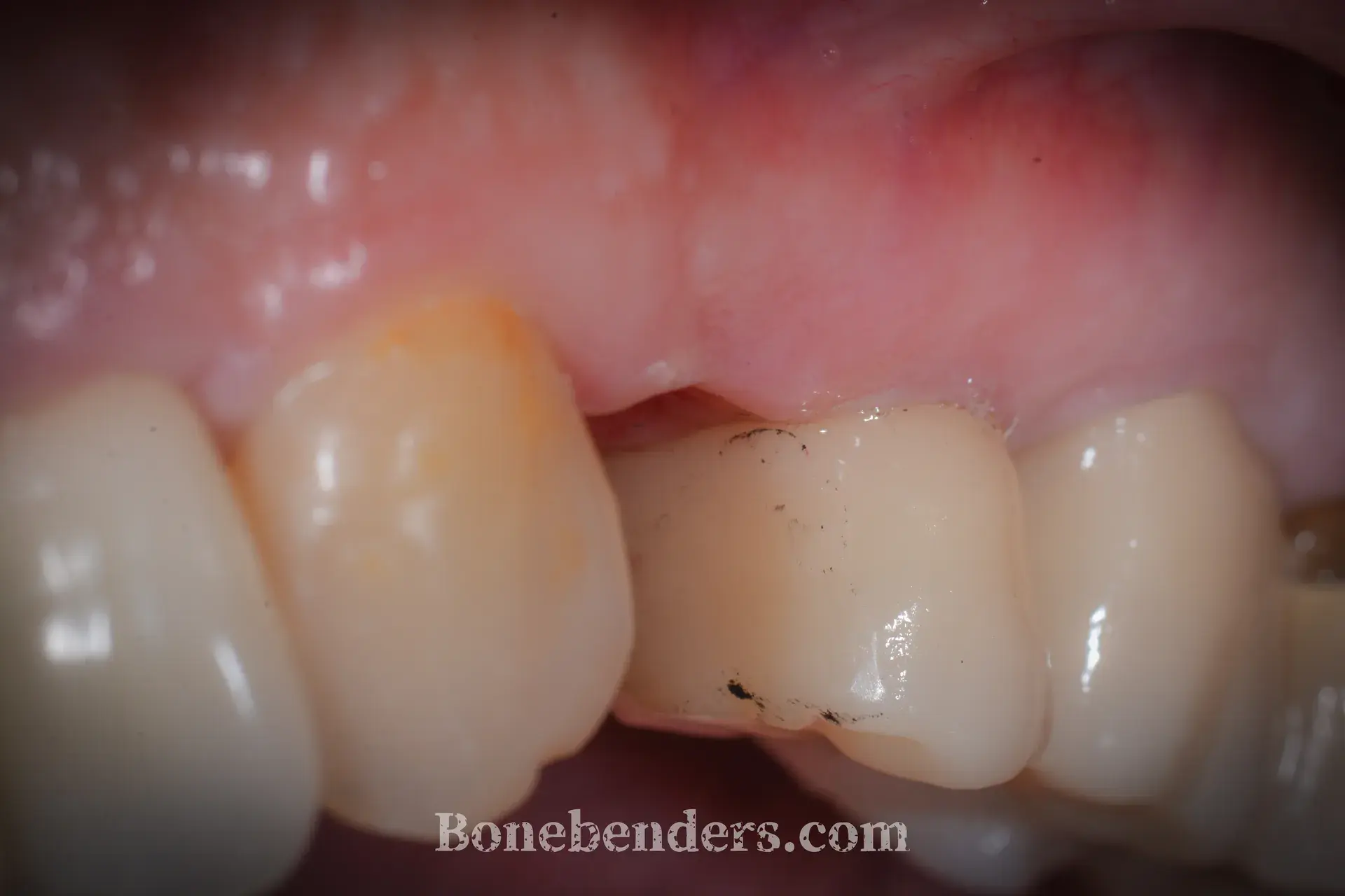 Primo premolare superiore sinistro compromesso da parodontite grave — situazione clinica pre-operatoria