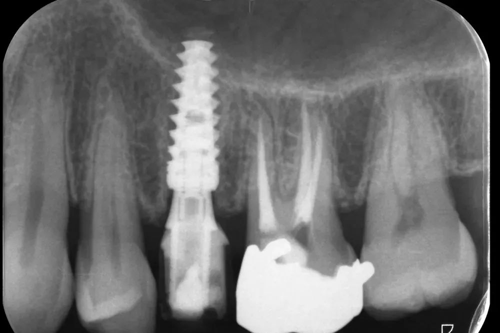 Impianto dentale immediato con corona provvisoria applicata