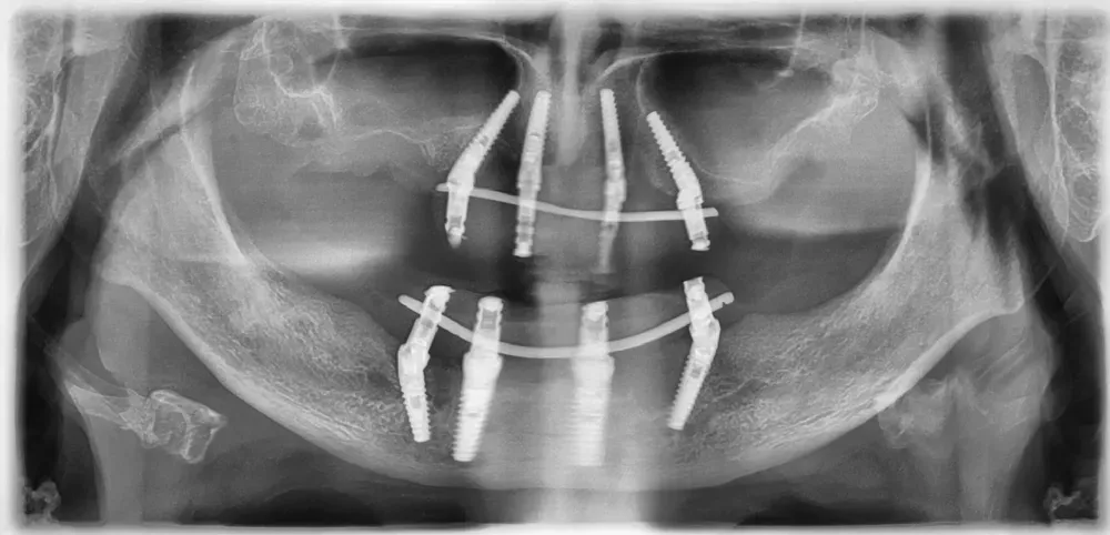 carico immediato in un giorno