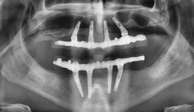 carico immediato all on 4