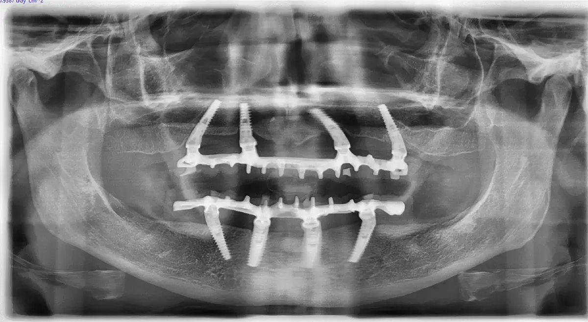 Carico Immediato: Tecnica, Vantaggi e Quando è Indicato