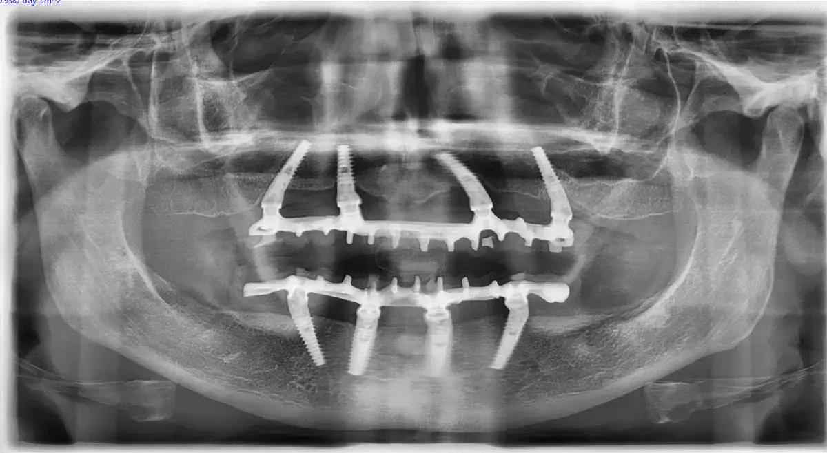 Carico Immediato: Tecnica, Vantaggi e Quando è Indicato