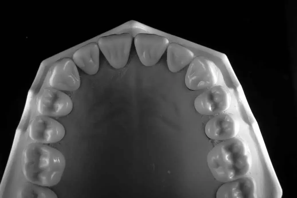 Your Front Teeth Are Moving Because You Lost a Molar