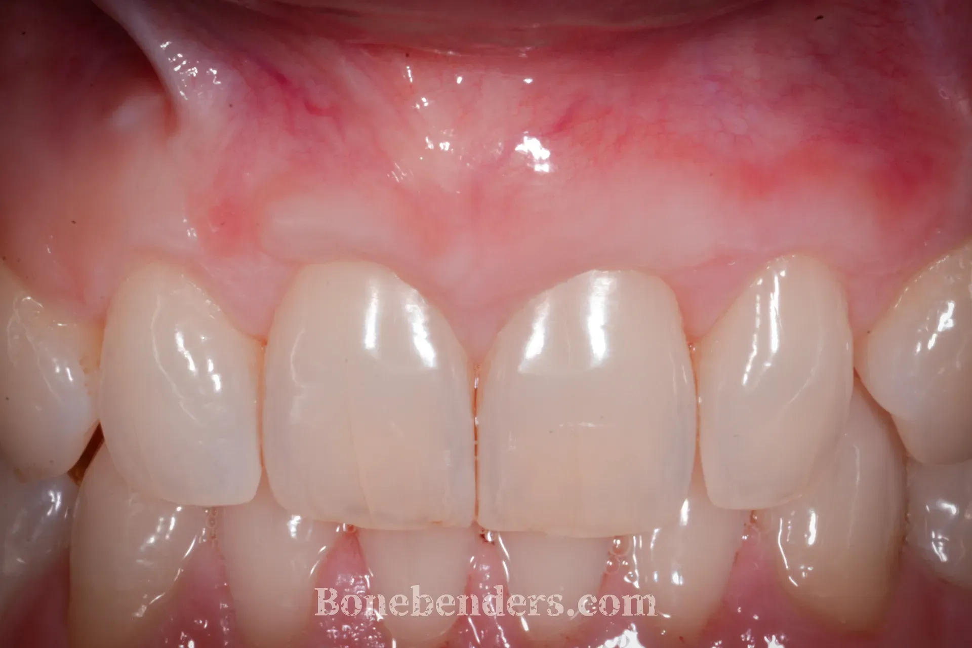 Copertura radicolare completa dopo innesto connettivale — risultato clinico a 3 mesi