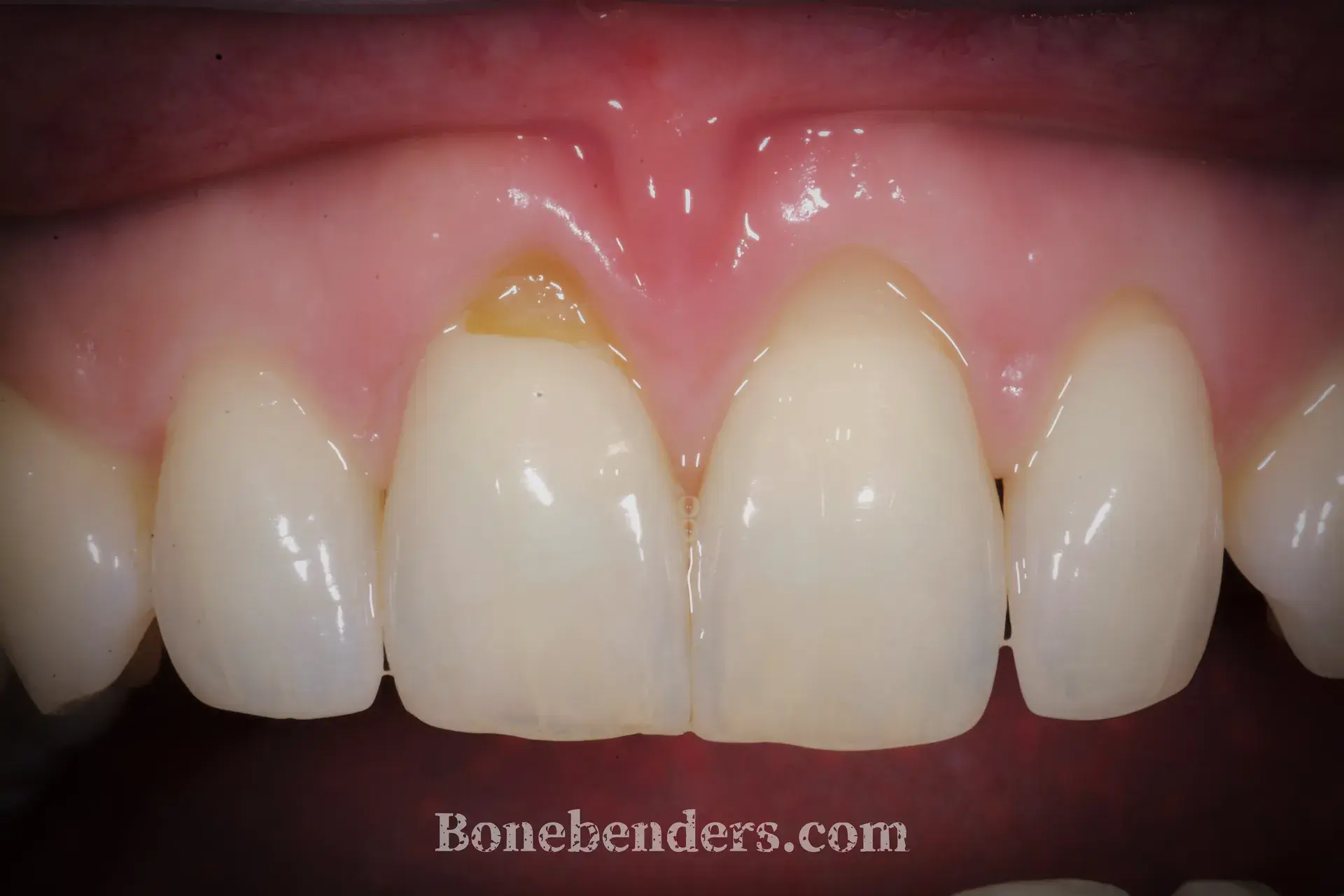 Recessioni gengivali gravi sugli incisivi superiori — situazione clinica pre-operatoria