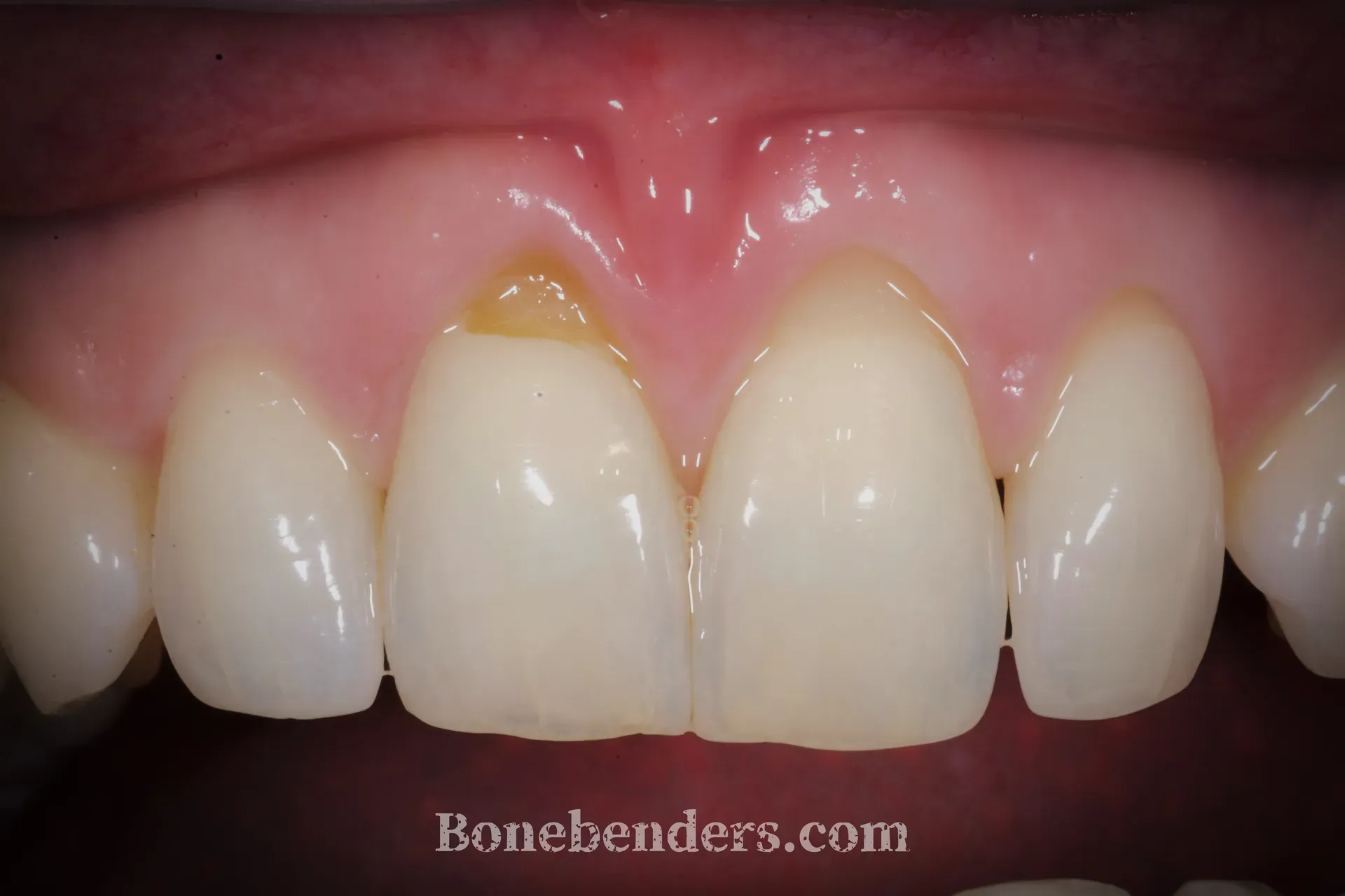 Recessioni gengivali gravi sugli incisivi superiori — situazione clinica pre-operatoria