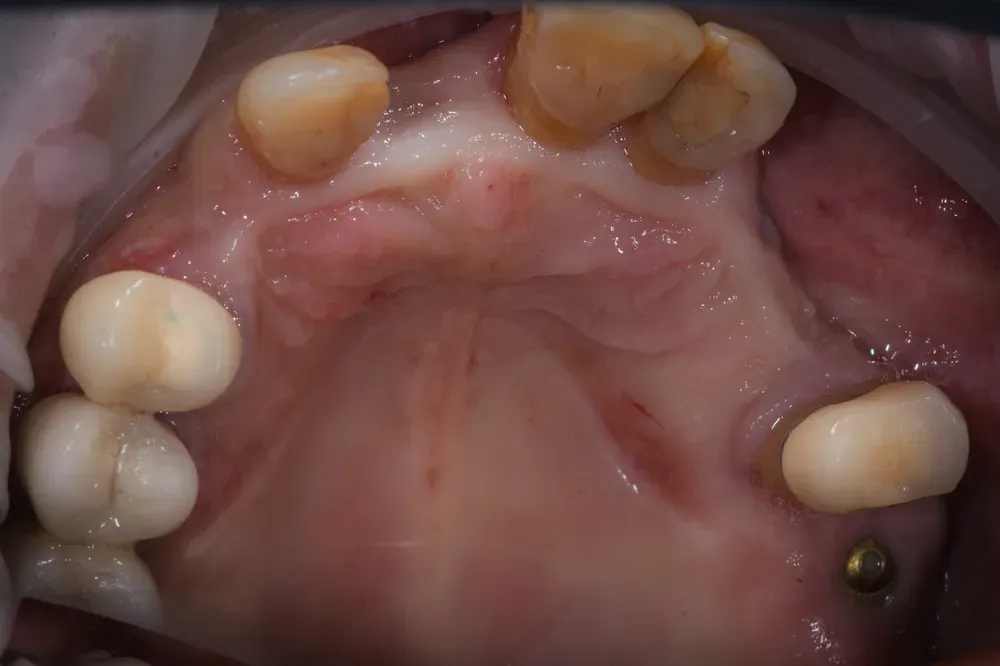 Arcata con in nuovi impianti ancora sommersi