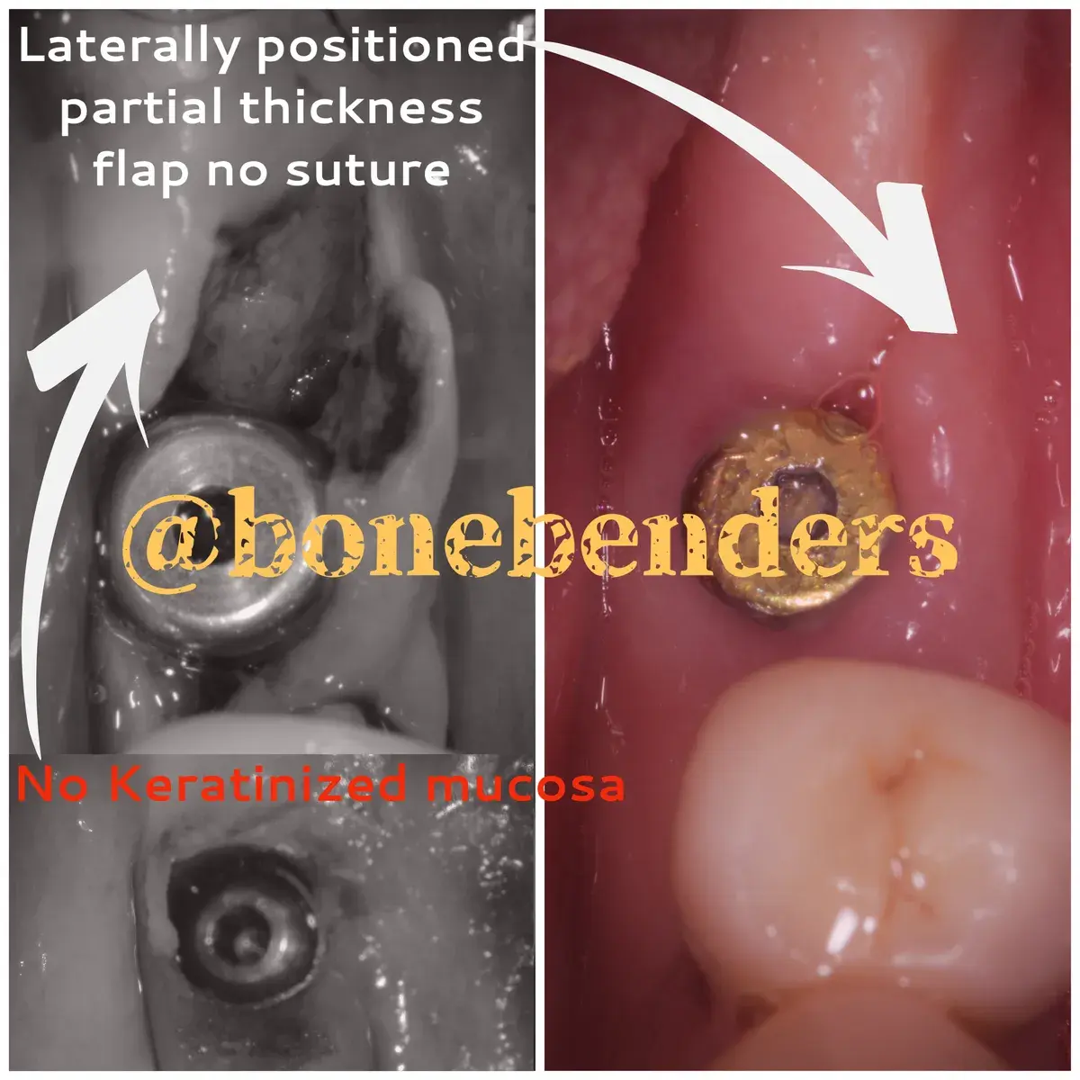 L’arte del lembo riposizionato lateralmente