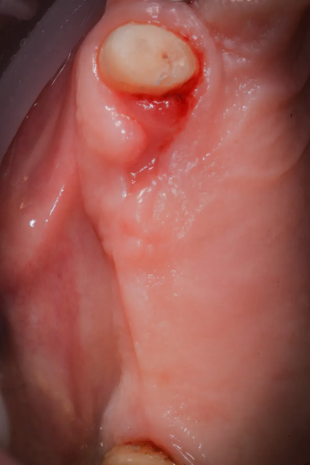 Mascellare destro pre-operatoria