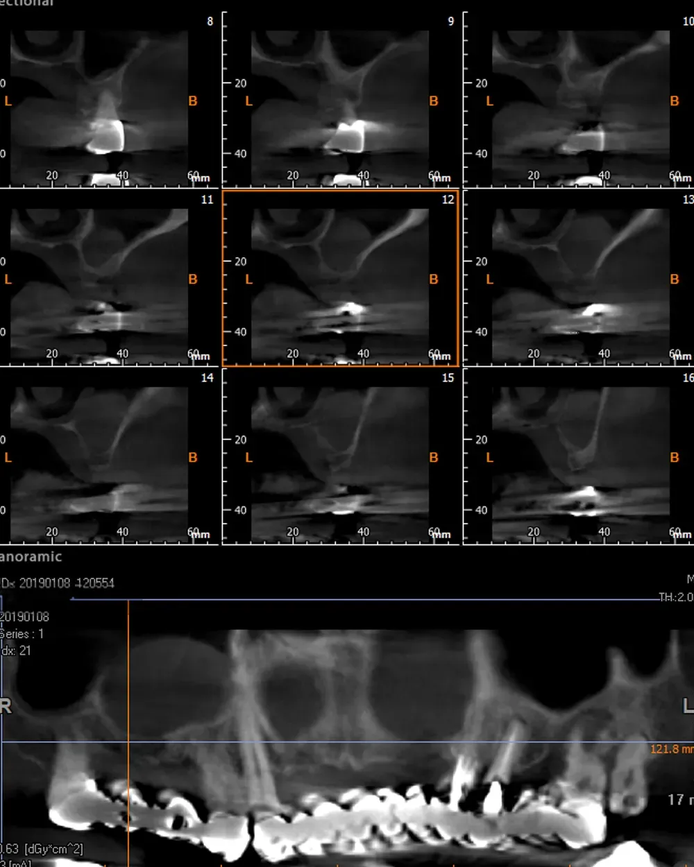 Atrofia mascellare zona 16 tipo S3
