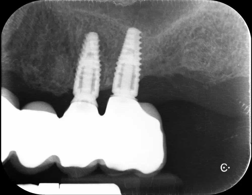 RX periapicale mascellare sinistra