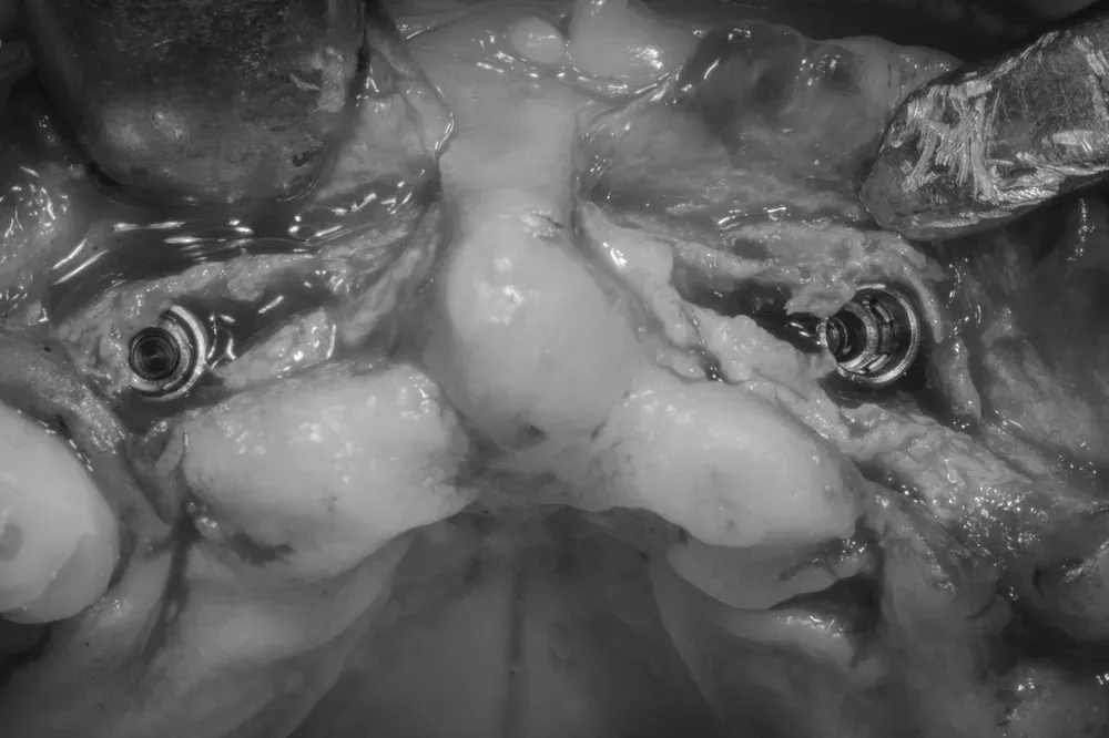 Espansione osteo-mucosa mascellare anteriore