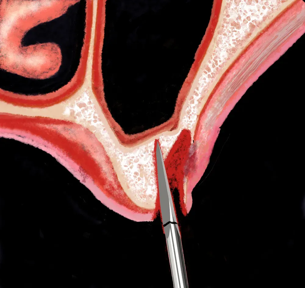 Illustration showing a lancet bur near the maxillary sinus, highlighting the path correction.