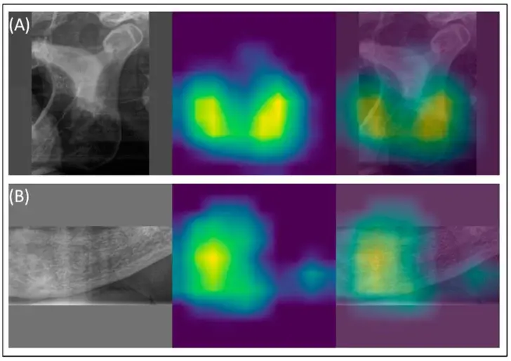 Visualizzazione GradCAM su panoramica dentale: le zone giallo-verdi indicano dove l'AI identifica i segni di osteoporosi nella corticale mandibolare.