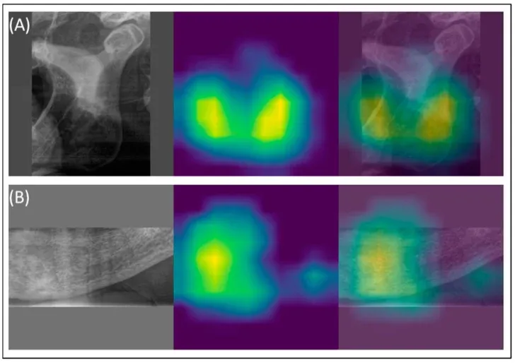 Visualizzazione GradCAM su panoramica dentale: le zone giallo-verdi indicano dove l'AI identifica i segni di osteoporosi nella corticale mandibolare.