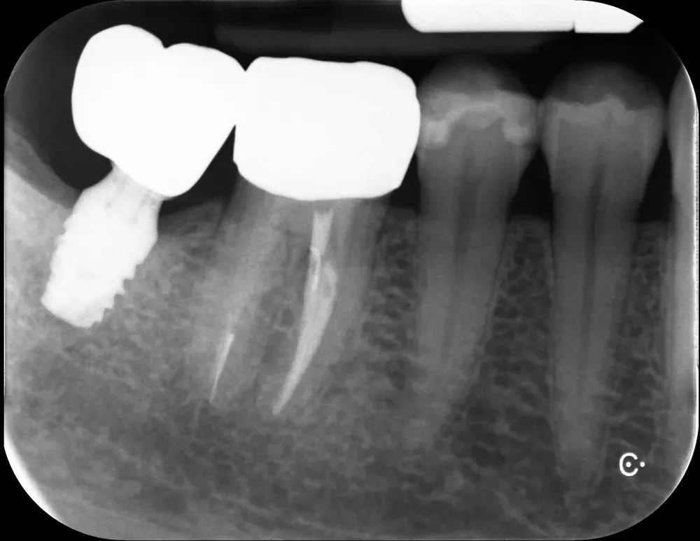 Impianto transmucoso