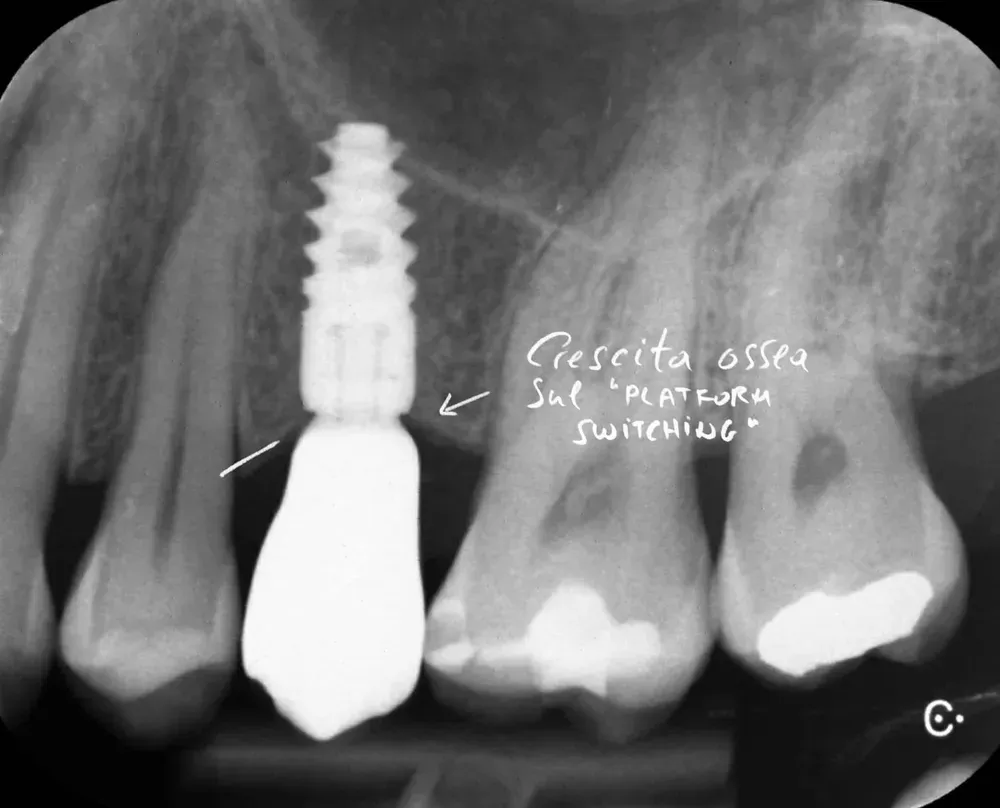 Radiogradia di Impianto a carico immediato a un anno dalla consegna della corona in ceramica definitiva con una splendida risposta dell