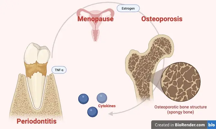 Osteoporosi e parodontite: la stessa biologia infiammatoria condivisa tra perdita di osso sistemica e riassorbimento alveolare.