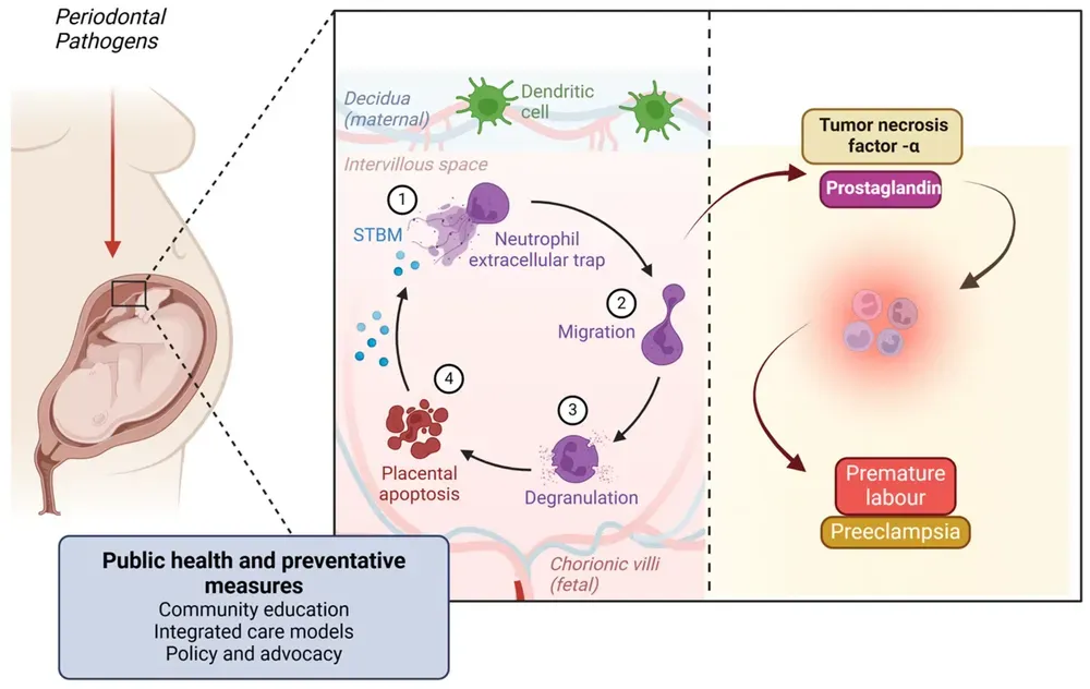 Diagram illustrating the mechanism through which periodontal pathogens can influence pregnancy, linking oral health to adverse outcomes such as preterm birth and preeclampsia.