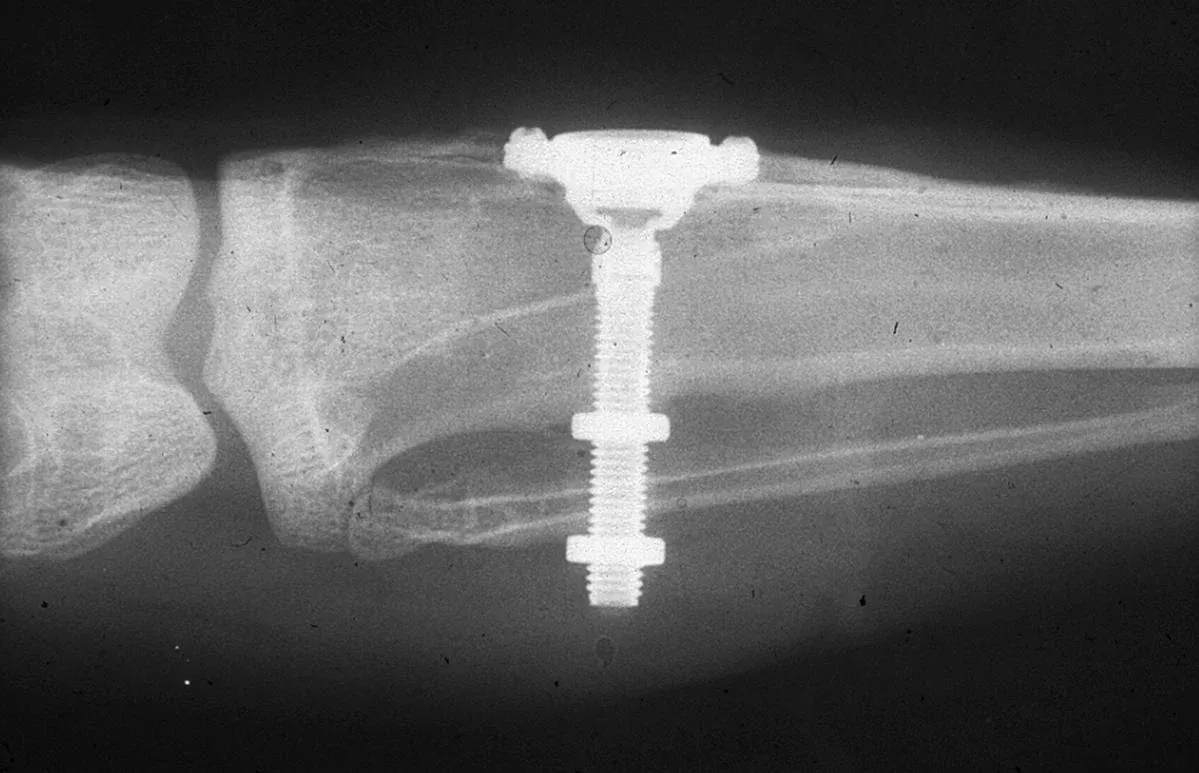 Radiografia originale di Brånemark: camera ottica in titanio nella fibula di un coniglio, 1952.