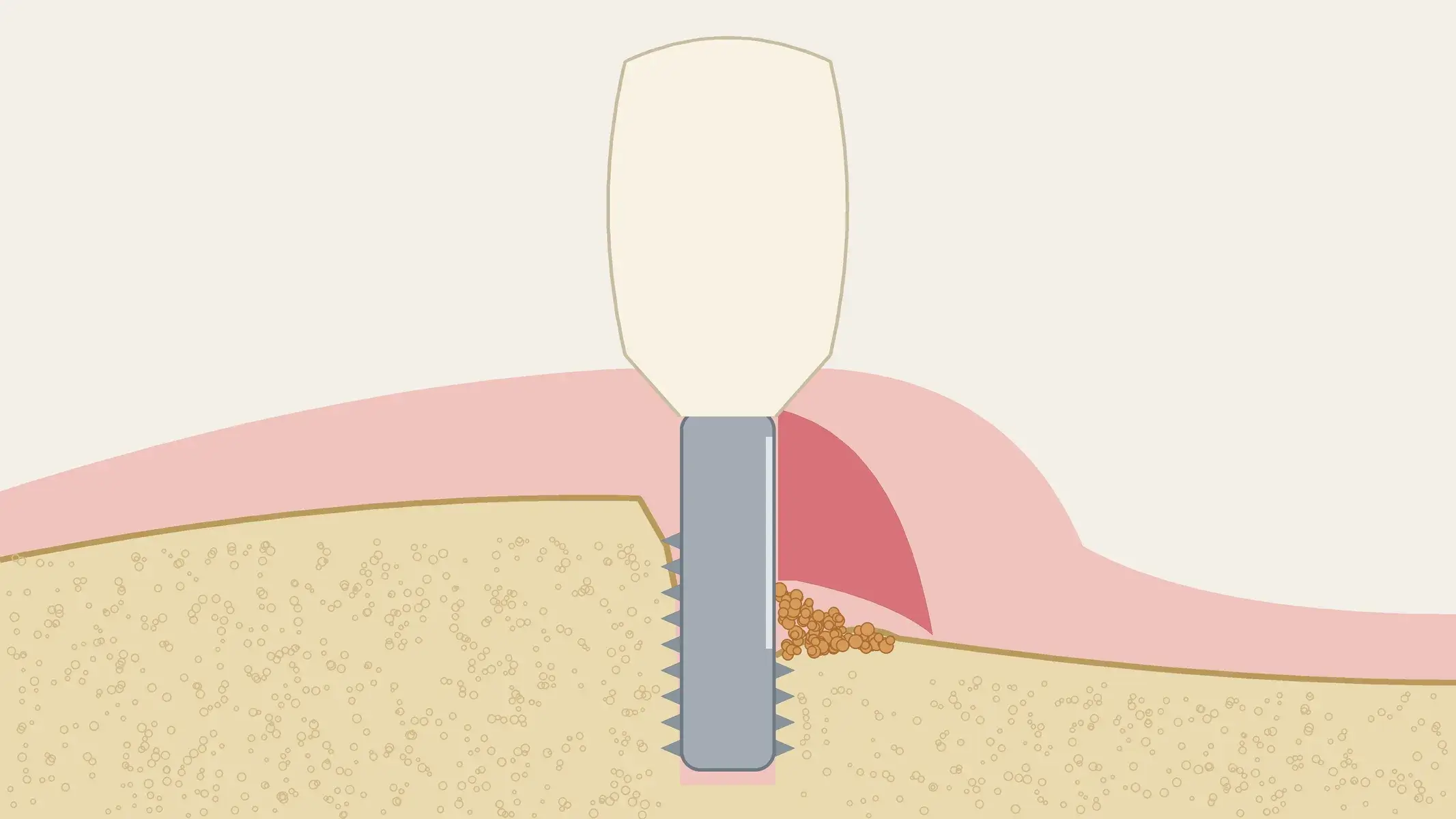 Schema in sezione di un impianto con peri-implantite trattata, con la superficie vestibolare levigata, granuli di xenoinnesto nel difetto infraosseo, e un innesto di connettivo che copre il titanio.