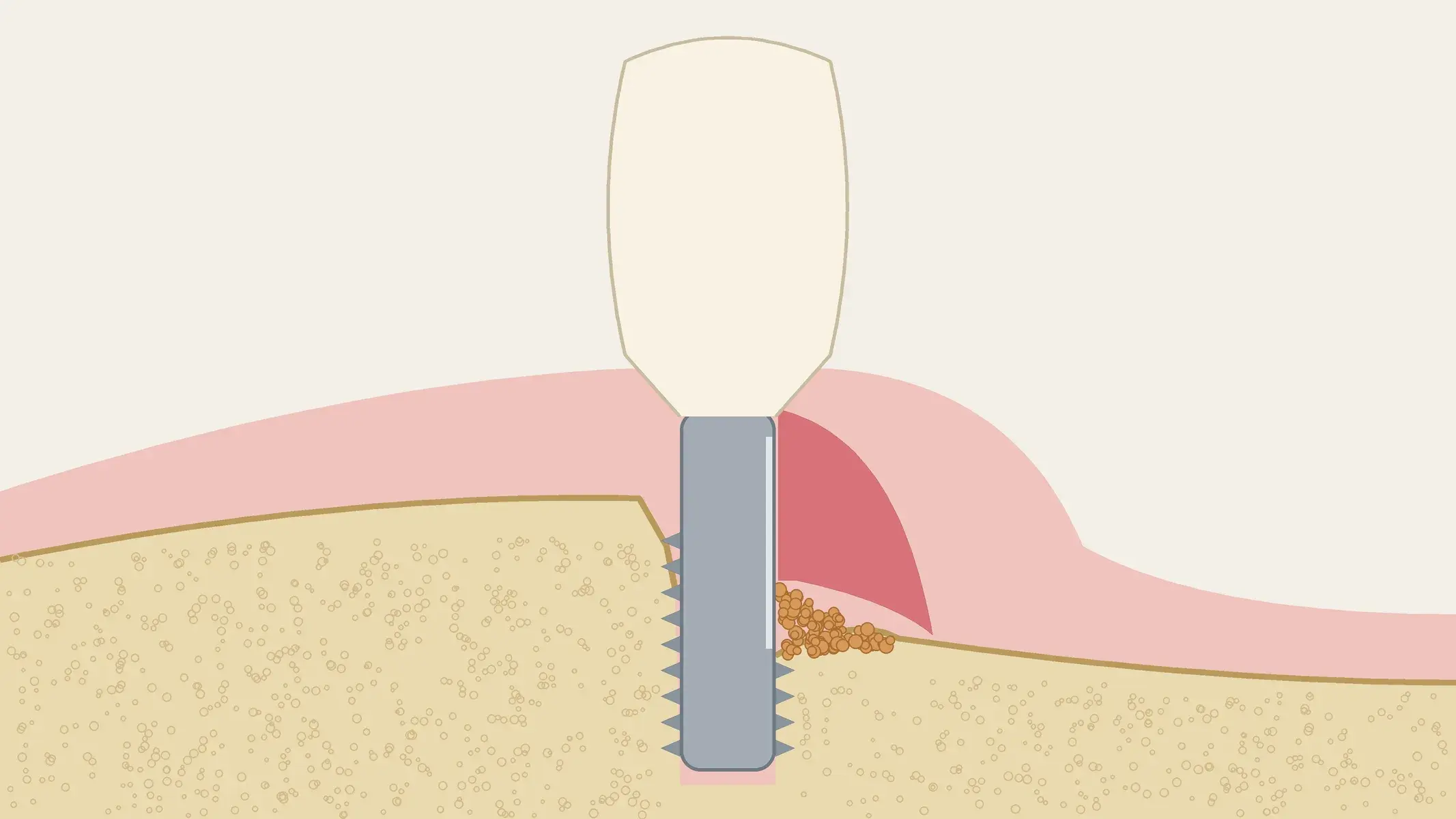 Schema in sezione di un impianto con peri-implantite trattata, con la superficie vestibolare levigata, granuli di xenoinnesto nel difetto infraosseo, e un innesto di connettivo che copre il titanio.
