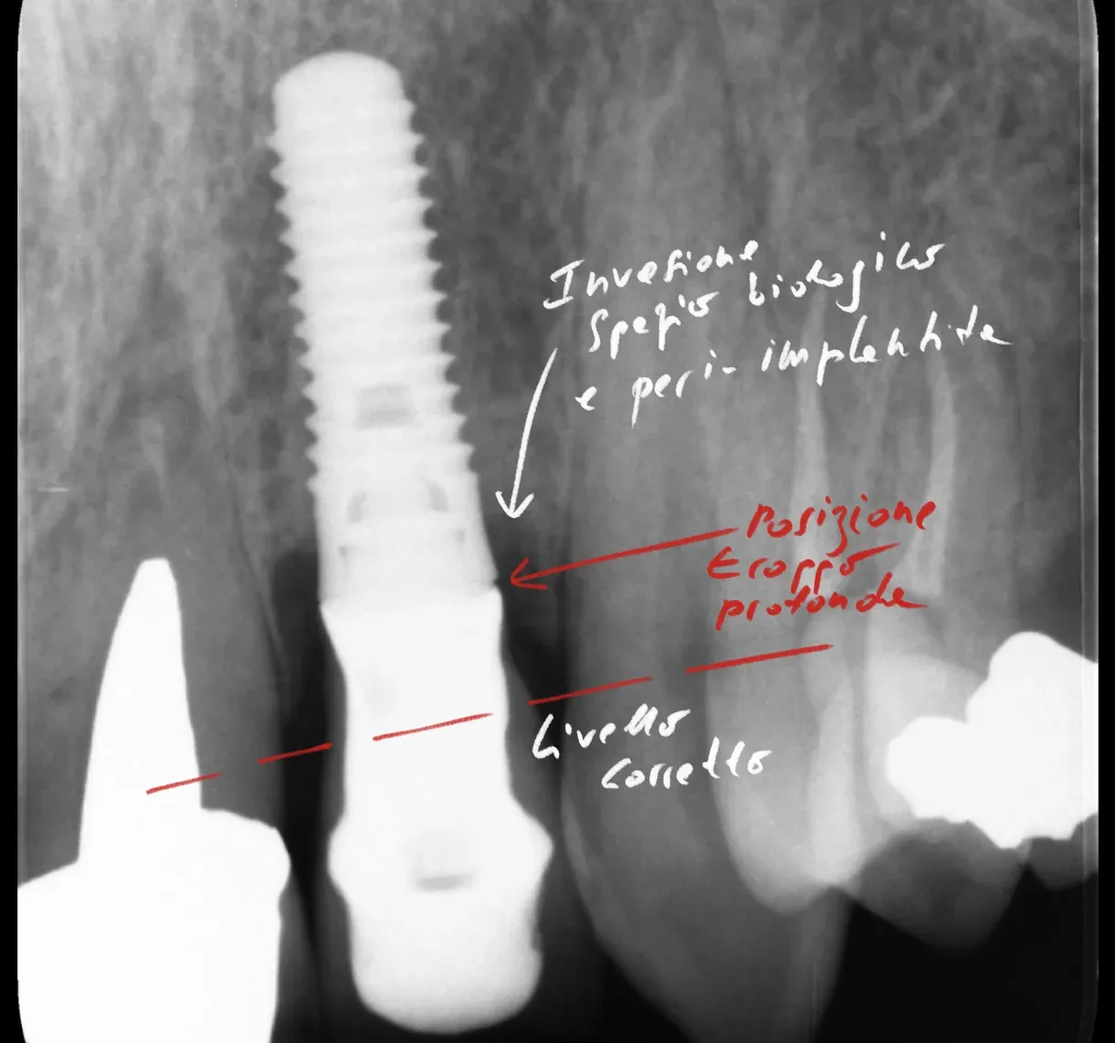 Radiograph of an implant affected by peri-implantitis from incorrect placement