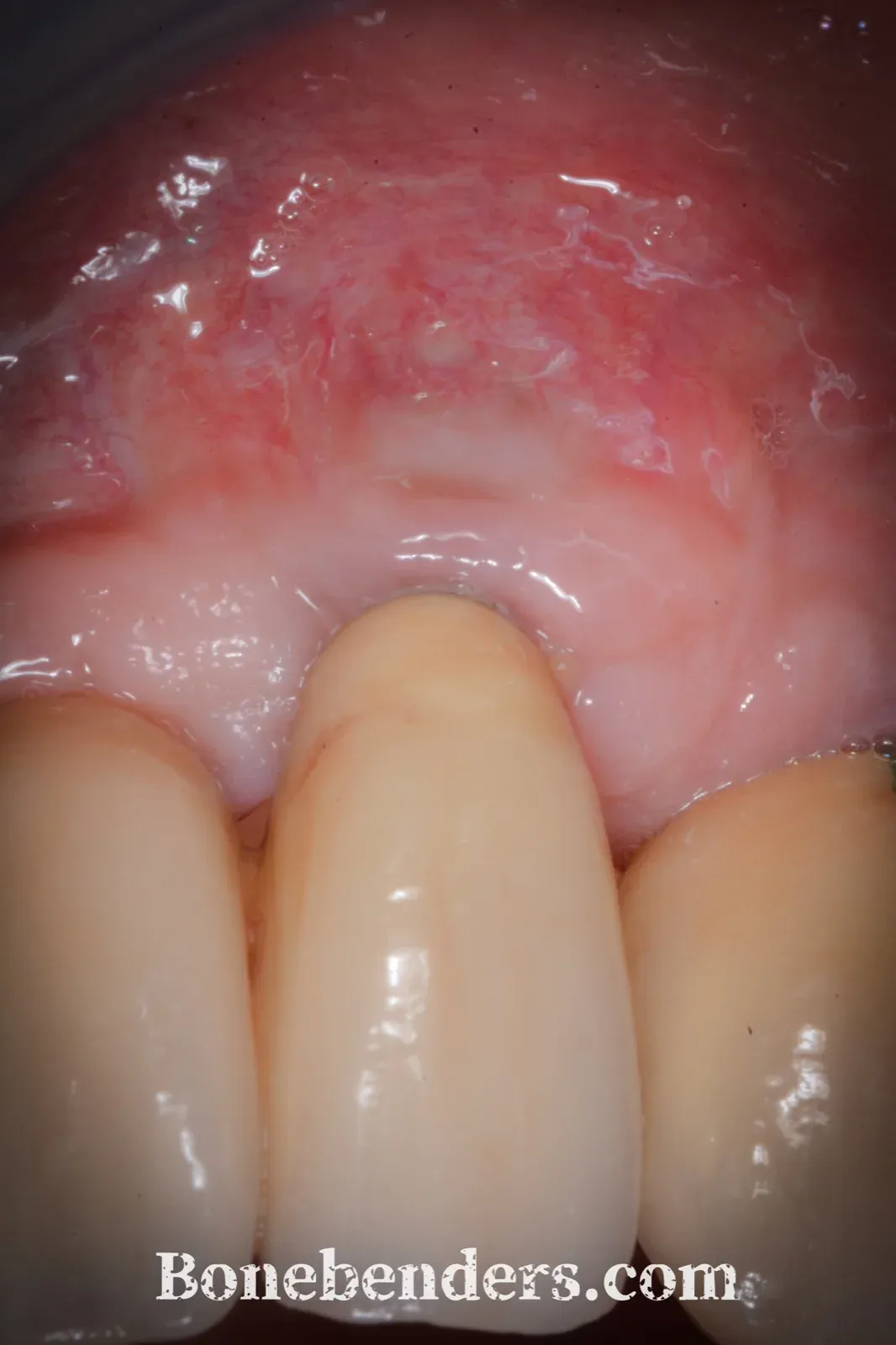 Impianto in 2.2 a tre anni: mucosa rosa, spessa e senza edema, nessuna superficie implantare visibile — fotografia intraorale di controllo