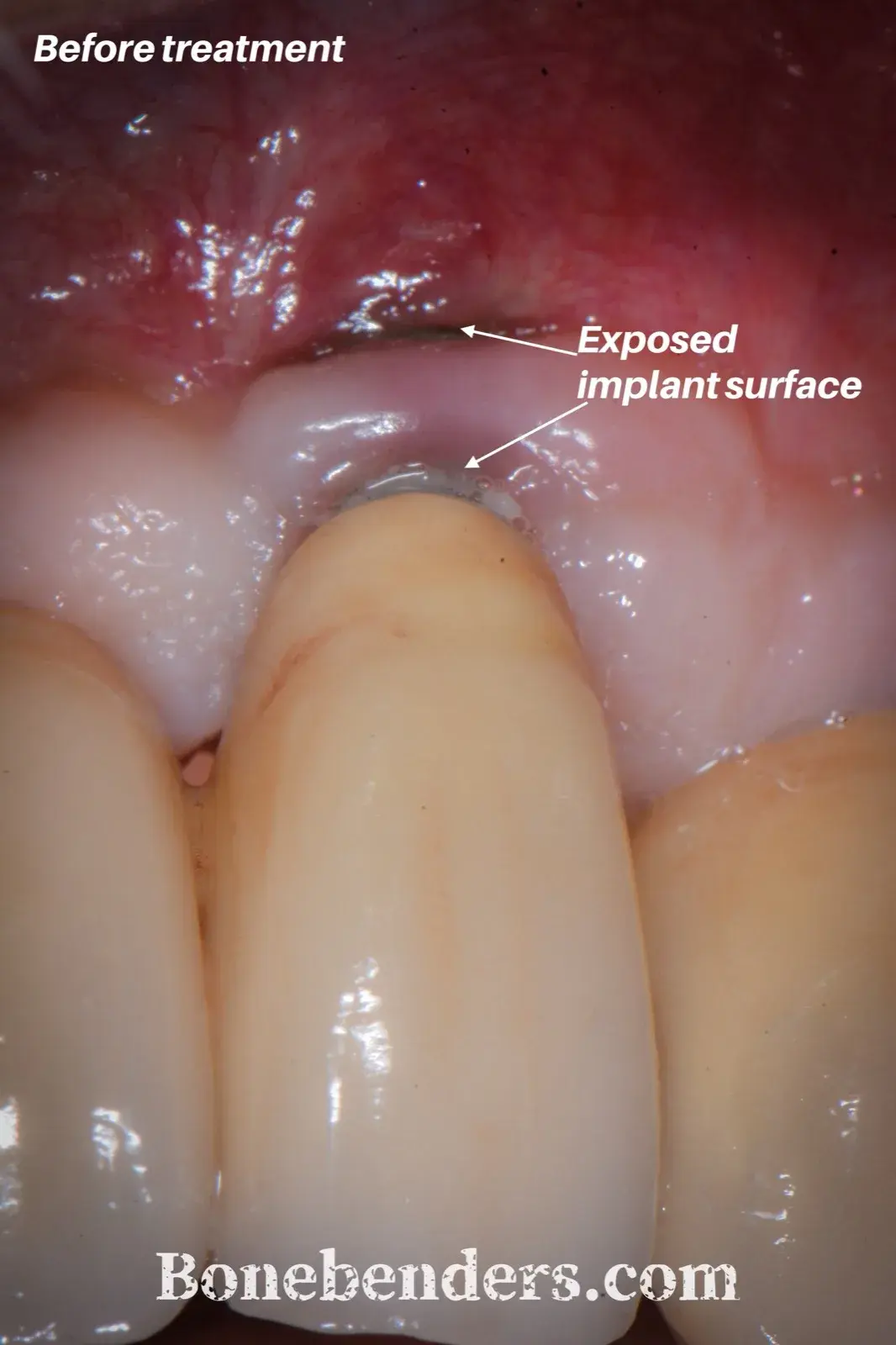 Impianto in 2.2 con mucosa peri-implantare arrossata e sottile: il collare lucido e l'inizio della superficie ruvida dell'impianto sono esposti — fotografia intraorale pre-operatoria