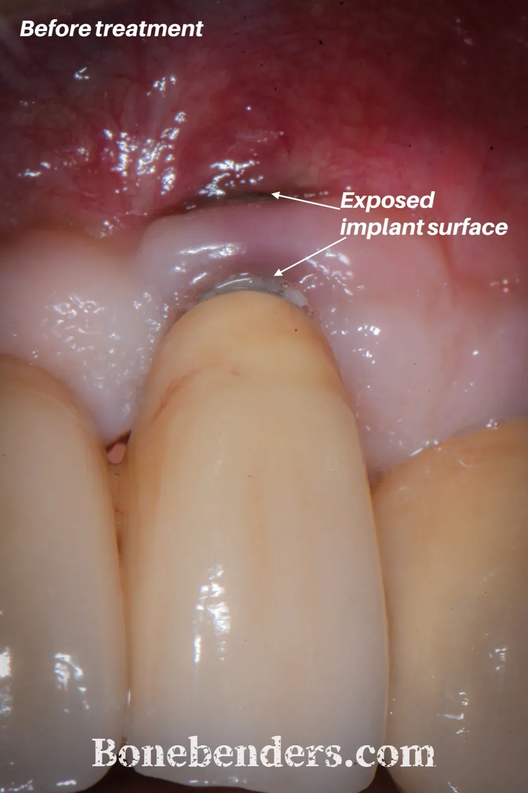 Impianto in 2.2 con mucosa peri-implantare arrossata e sottile: il collare lucido e l'inizio della superficie ruvida dell'impianto sono esposti — fotografia intraorale pre-operatoria