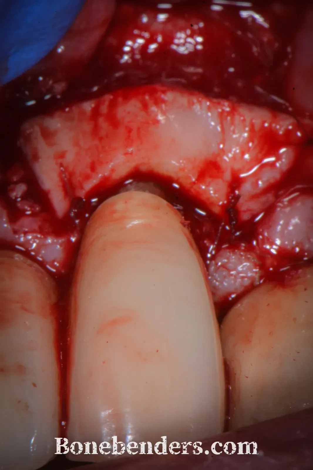 Subepithelial connective tissue graft from the palate positioned over the grafted defect and the treated implant surface, secured with sutures