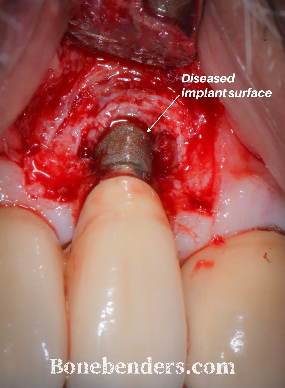 Partial-thickness flap raised: the buccal defect and the contaminated implant surface after removal of granulation tissue