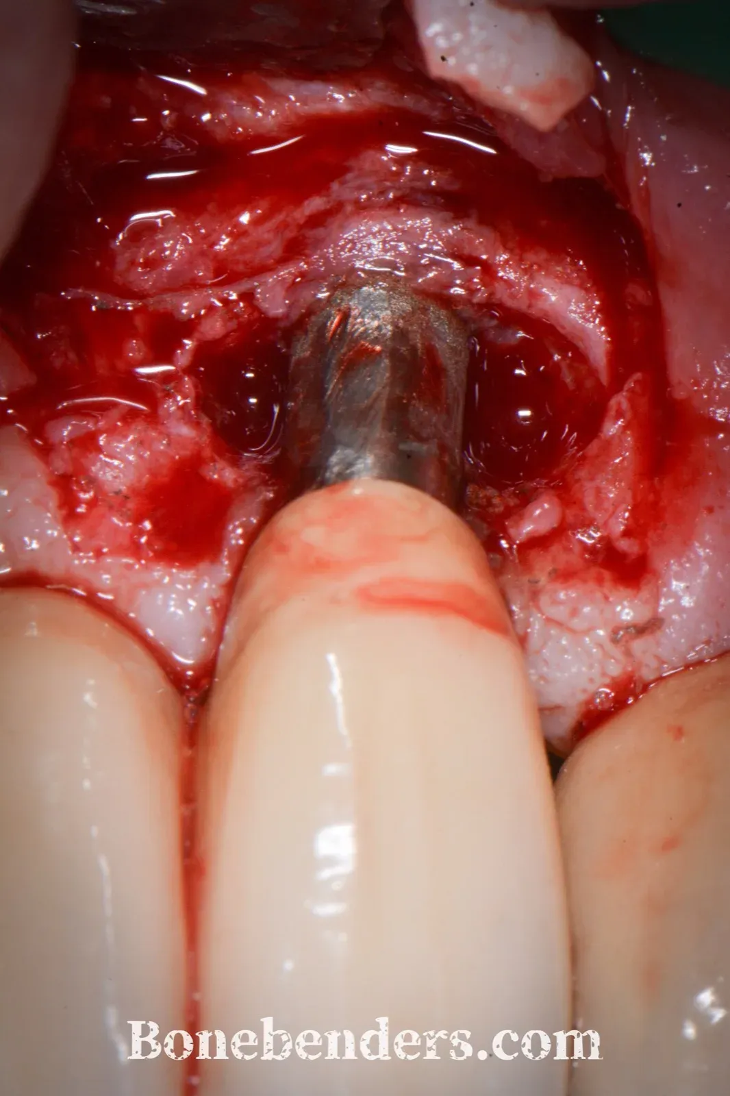 The exposed surface after implantoplasty with rotary instruments: the threads have been removed and the surface is smooth