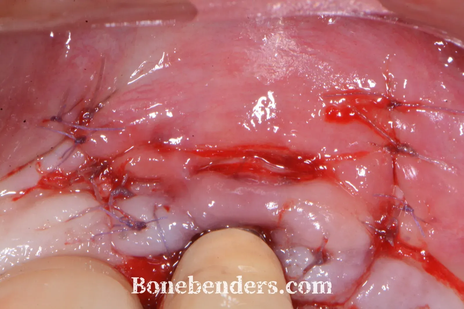 Coronally advanced flap sutured for tension-free primary coverage of the graft