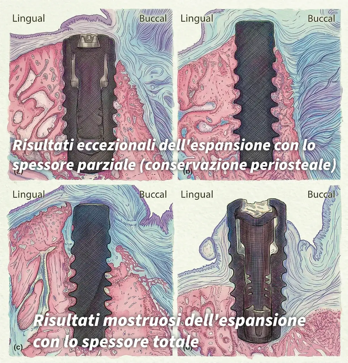 Confronto tra espansione crestale con lembo a spessore parziale e a spessore totale