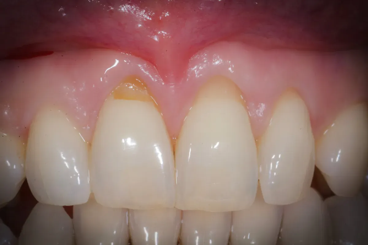 Quando occorre un innesto gengivale e quando no?