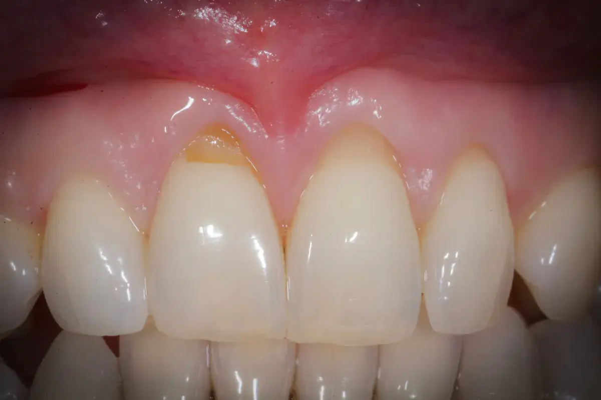 Quando occorre un innesto gengivale e quando no?