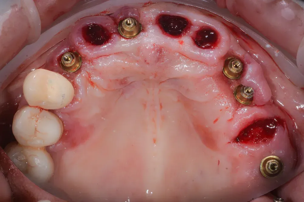 Widened arch — extractions and mucosal expansion
