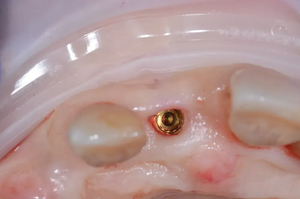 A new implant just placed