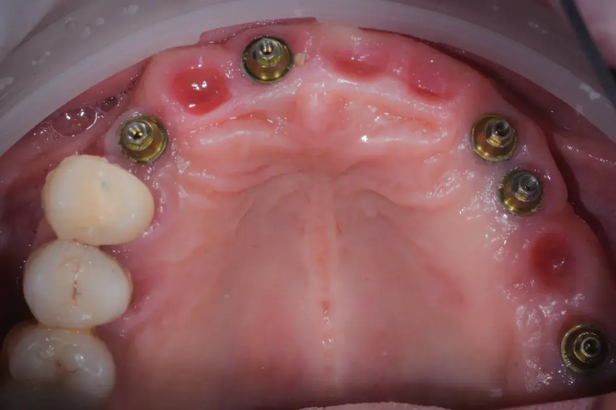 Rebuilding an implant-supported prosthesis that no longer holds